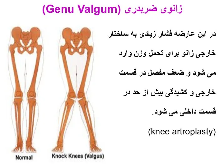 در این عارضه فشار زیادی به ساختار خارجی زانو برای تحمل وزن