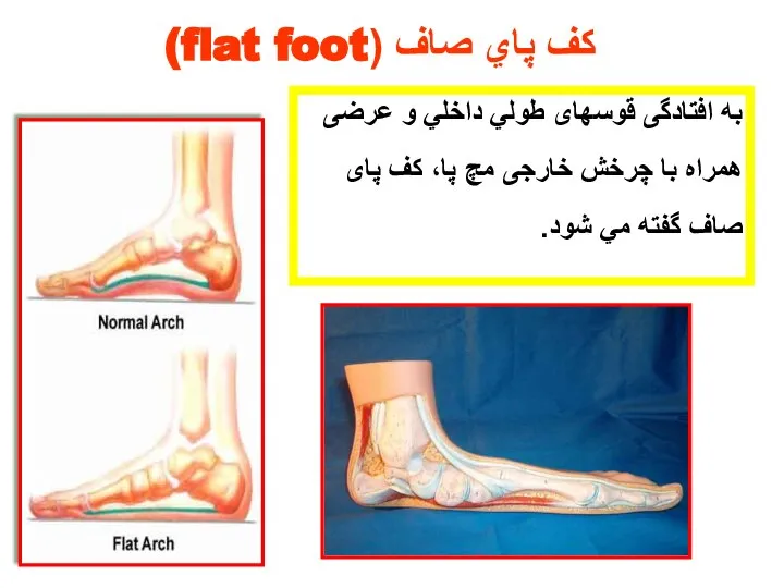 كف پاي صاف (flat foot) به افتادگی قوسهای طولي داخلي و عرضی