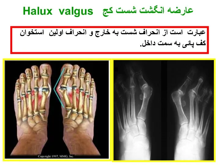 عارضه انگشت شست کج Halux valgus عبارت است از انحراف شست به