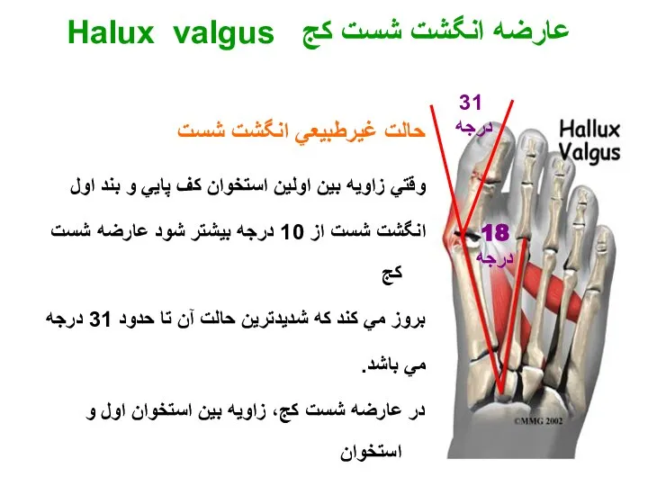 حالت غيرطبيعي انگشت شست وقتي زاويه بين اولين استخوان كف پايي و