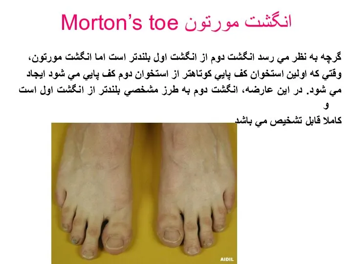 Morton’s toe انگشت مورتون گرچه به نظر مي رسد انگشت دوم از