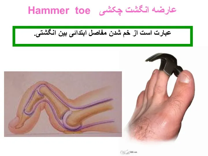 عارضه انگشت چکشی Hammer toe عبارت است از خم شدن مفاصل ابتدائی بین انگشتی.