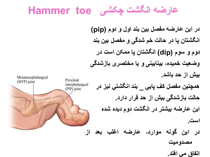 عارضه انگشت چکشی Hammer toe در اين عارضه مفصل بين بند اول