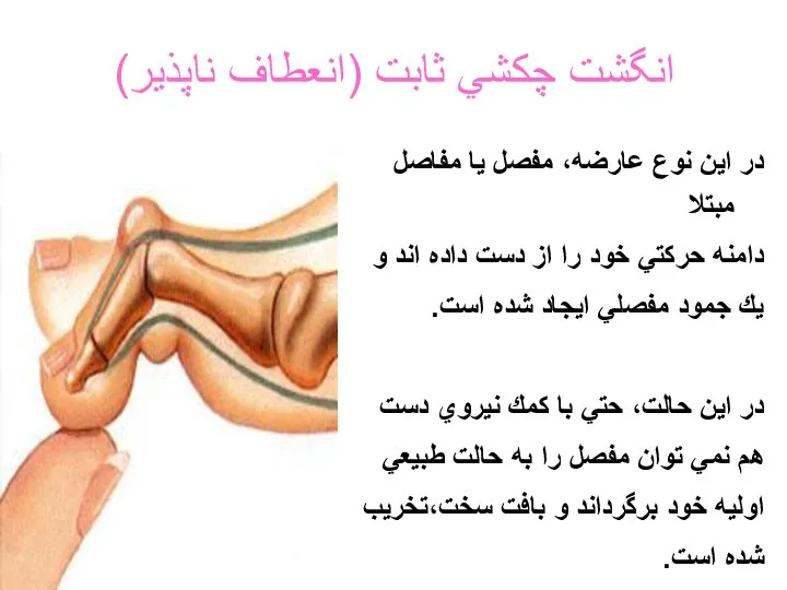 انگشت چكشي ثابت (انعطاف ناپذير) در اين نوع عارضه، مفصل يا مفاصل