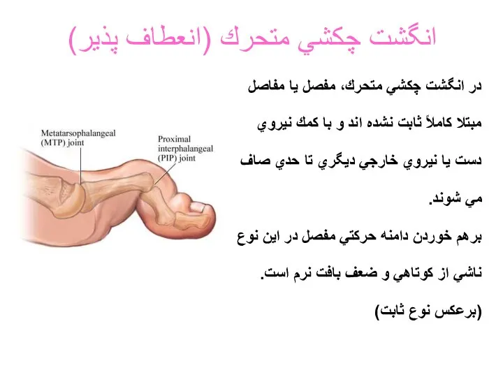 انگشت چكشي متحرك (انعطاف پذير) در انگشت چكشي متحرك، مفصل يا مفاصل