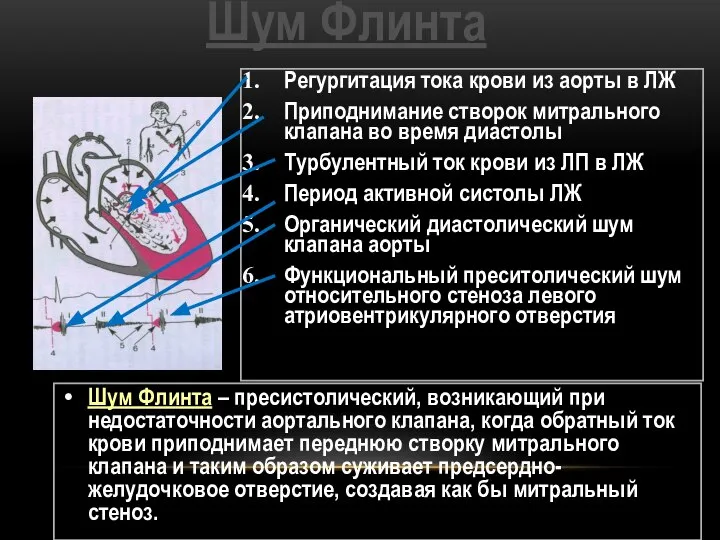 Шум Флинта Регургитация тока крови из аорты в ЛЖ Приподнимание створок митрального