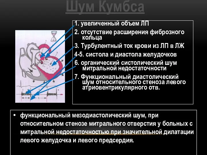 Шум Кумбса 1. увеличенный объем ЛП 2. отсутствие расширения фиброзного кольца 3.