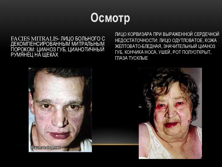 Осмотр FACIES MITRALIS- ЛИЦО БОЛЬНОГО С ДЕКОМПЕНСИРОВАННЫМ МИТРАЛЬНЫМ ПОРОКОМ: ЦИАНОЗ ГУБ, ЦИАНОТИЧНЫЙ