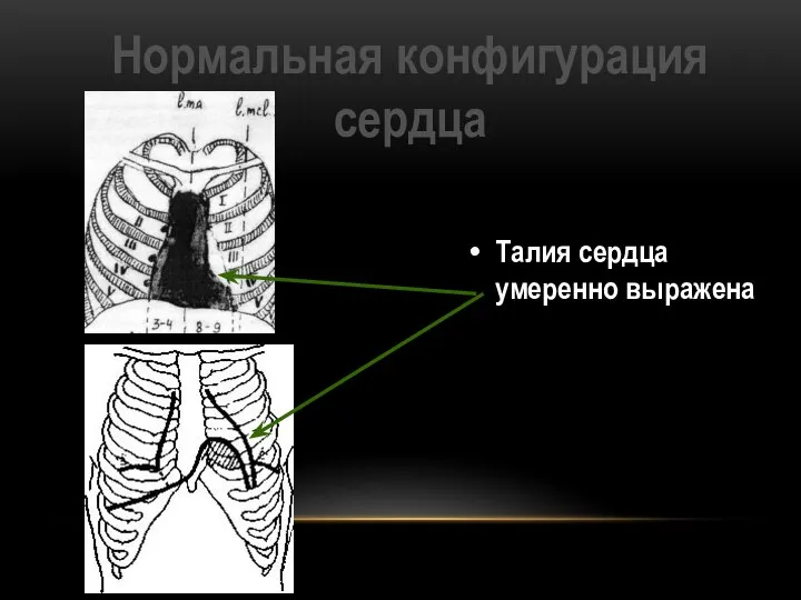 Нормальная конфигурация сердца Талия сердца умеренно выражена