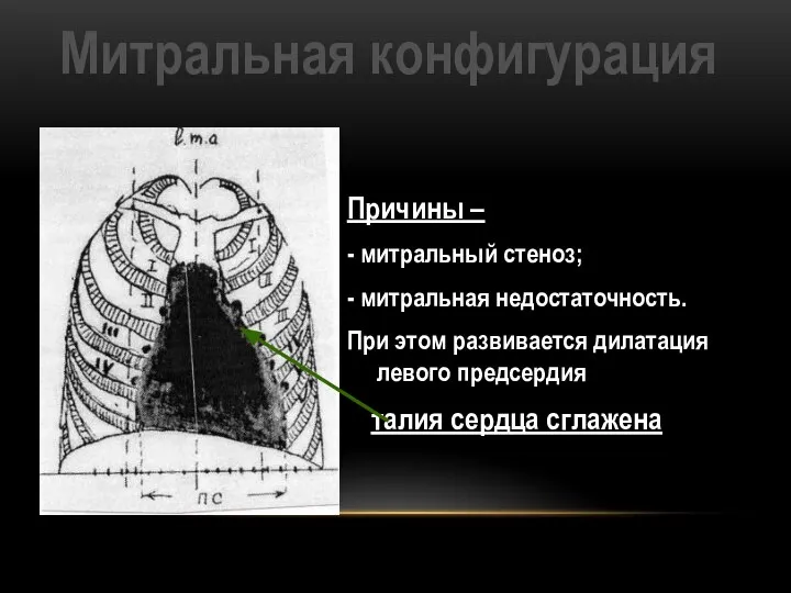 Митральная конфигурация Причины – - митральный стеноз; - митральная недостаточность. При этом