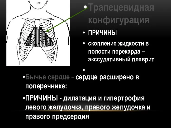 Трапецевидная конфигурация ПРИЧИНЫ скопление жидкости в полости перекарда – экссудативный плеврит Бычье