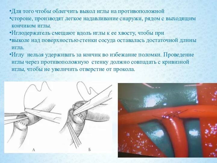 Для того чтобы облегчить выкол иглы на противоположной стороне, производят легкое надавливание