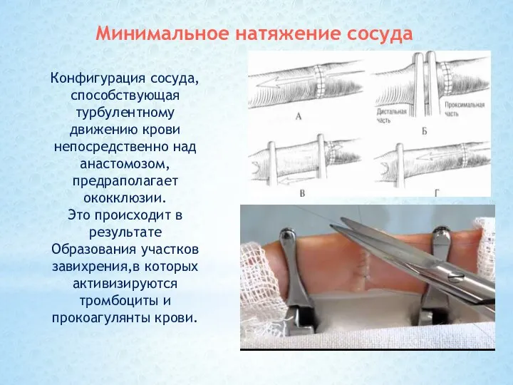 Конфигурация сосуда, способствующая турбулентному движению крови непосредственно над анастомозом, предраполагает ококклюзии. Это