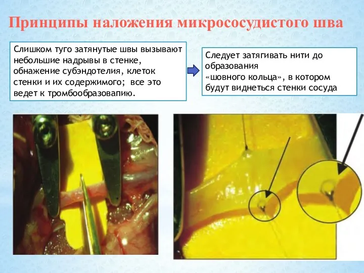 Слишком туго затянутые швы вызывают небольшие надрывы в стенке, обнажение субэндотелия, клеток
