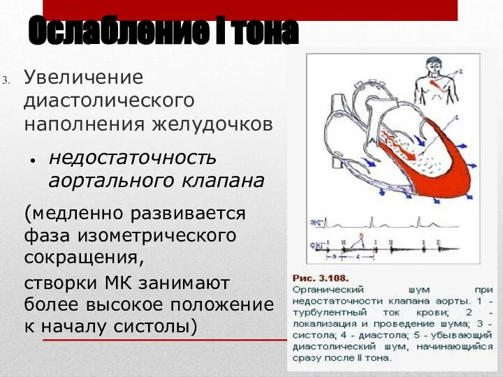 Ослабление I тона Увеличение диастолического наполнения желудочков недостаточность аортального клапана (медленно развивается