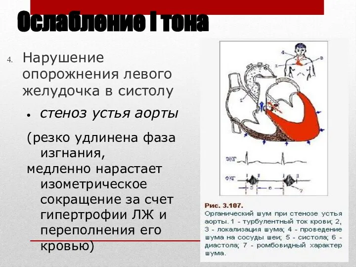 Ослабление I тона Нарушение опорожнения левого желудочка в систолу стеноз устья аорты