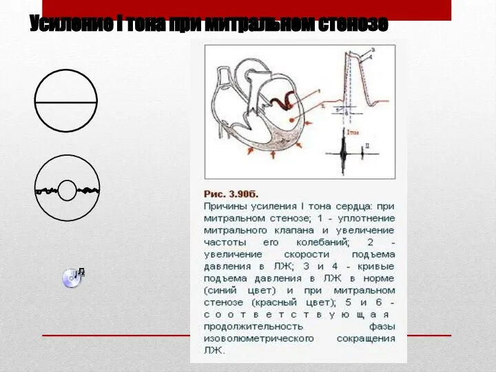 Усиление I тона при митральном стенозе