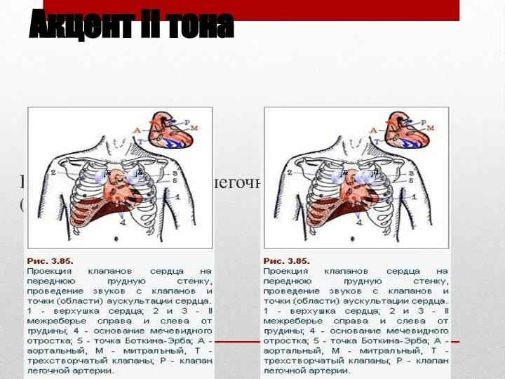 Акцент II тона На аорте (при АГ) На легочной артерии (при митральном стенозе)