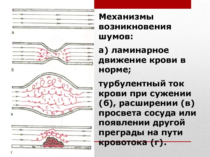 Механизмы возникновения шумов: а) ламинарное движение крови в норме; турбулентный ток крови