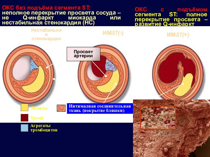 ИМST(-) Нестабильная стенокардия Липиды Тромб Агрегаты тромбоцитов Просвет артерии ИМST(+) Интималная соединительная