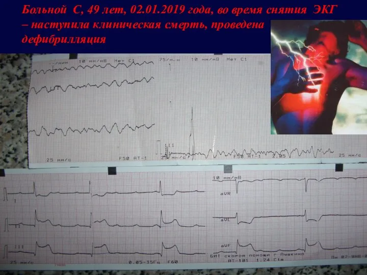 Больной С, 49 лет, 02.01.2019 года, во время снятия ЭКГ – наступила клиническая смерть, проведена дефибрилляция