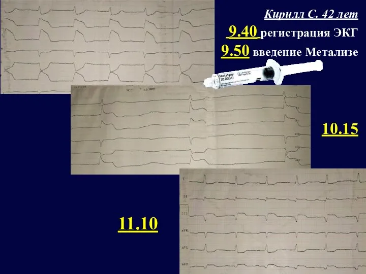 Кирилл С. 42 лет 9.40 регистрация ЭКГ 9.50 введение Метализе 10.15 11.10