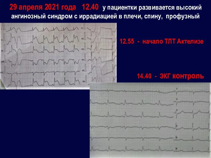 29 апреля 2021 года 12.40 у пациентки развивается высокий ангинозный синдром с