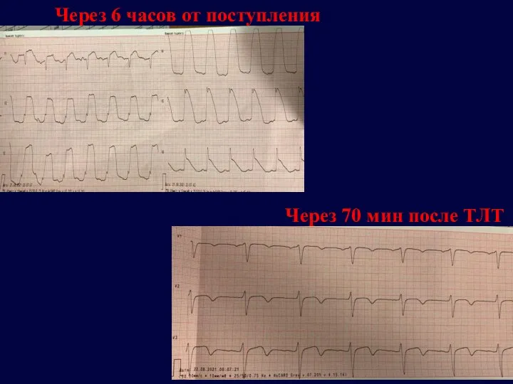 Через 6 часов от поступления Через 70 мин после ТЛТ