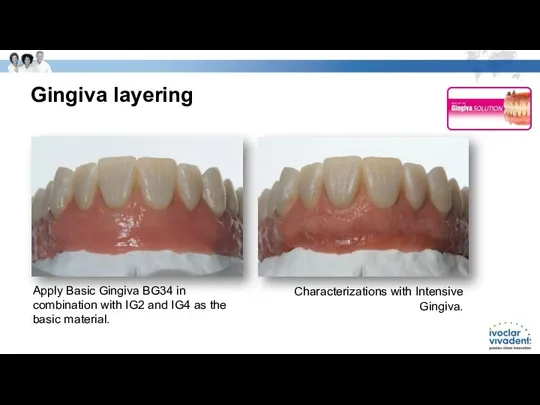Gingiva layering Apply Basic Gingiva BG34 in combination with IG2 and IG4