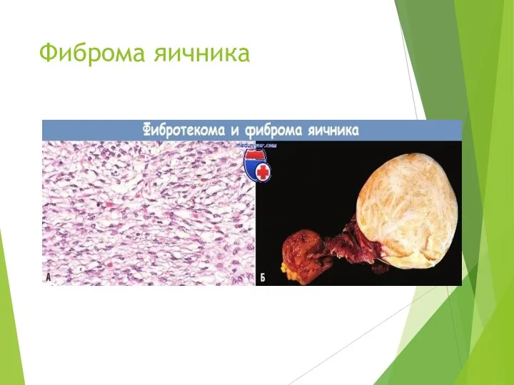 Фиброма яичника