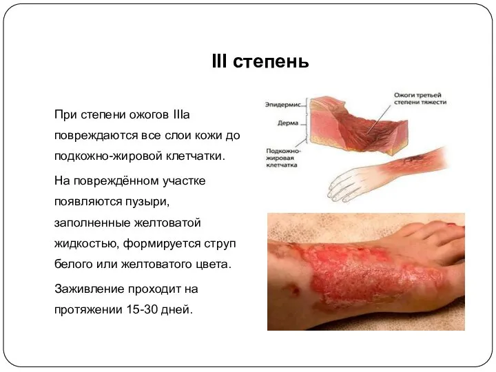 III степень При степени ожогов IIIа повреждаются все слои кожи до подкожно-жировой