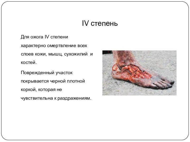 IV степень Для ожога IV степени характерно омертвление всех слоев кожи, мышц,