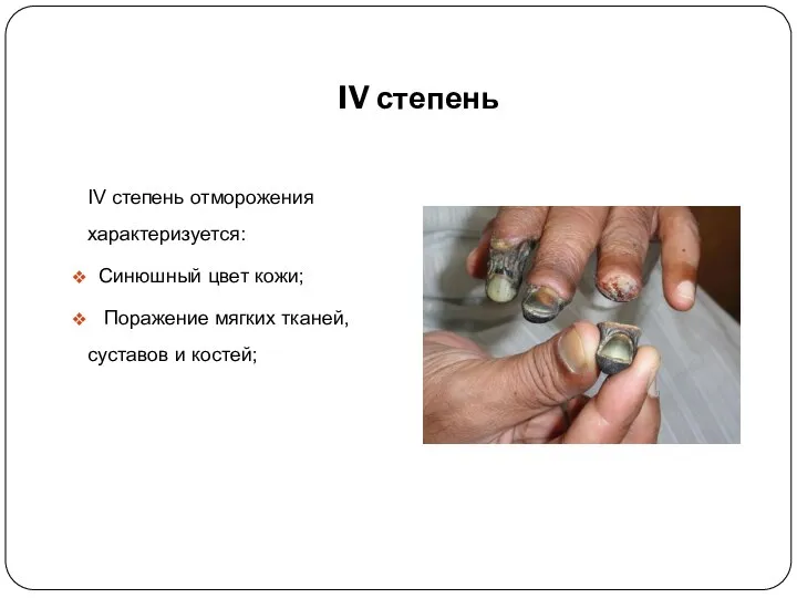 IV степень IV степень отморожения характеризуется: Синюшный цвет кожи; Поражение мягких тканей, суставов и костей;