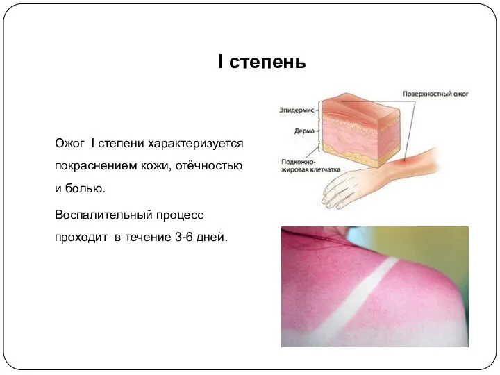 I степень Ожог I степени характеризуется покраснением кожи, отёчностью и болью. Воспалительный