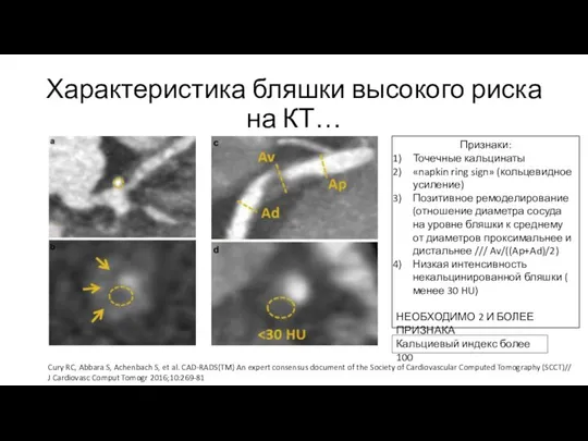 Характеристика бляшки высокого риска на КТ… Признаки: Точечные кальцинаты «napkin ring sign»