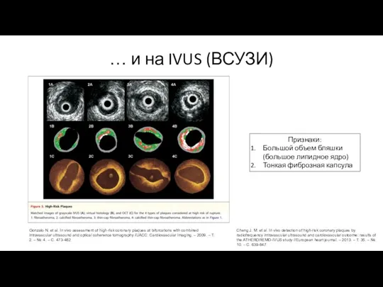 … и на IVUS (ВСУЗИ) Cheng J. M. et al. In vivo