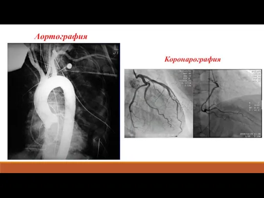 Аортография Коронарография