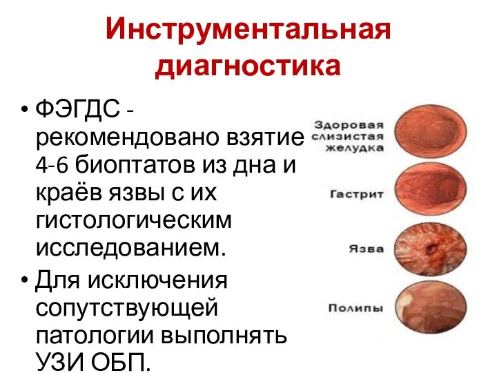 Инструментальная диагностика ФЭГДС - рекомендовано взятие 4-6 биоптатов из дна и краёв