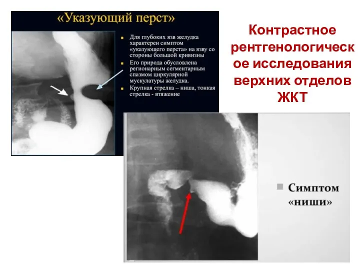 Контрастное рентгенологическое исследования верхних отделов ЖКТ