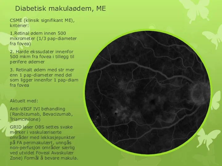 Diabetisk makulaødem, ME CSME (klinsik signifikant ME), kriterier: 1.Retinal ødem innen 500