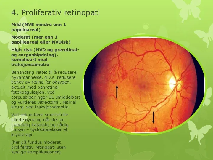 4. Proliferativ retinopati Mild (NVE mindre enn 1 papilleareal) Moderat (mer enn