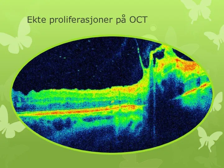 Ekte proliferasjoner på OCT