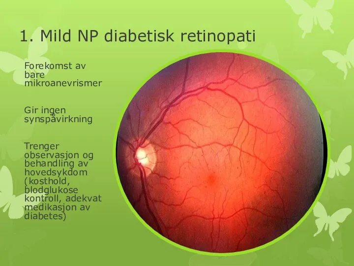 1. Mild NP diabetisk retinopati Forekomst av bare mikroanevrismer Gir ingen synspåvirkning