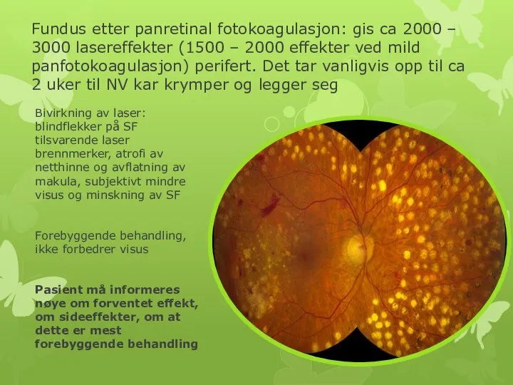 Fundus etter panretinal fotokoagulasjon: gis ca 2000 – 3000 lasereffekter (1500 –