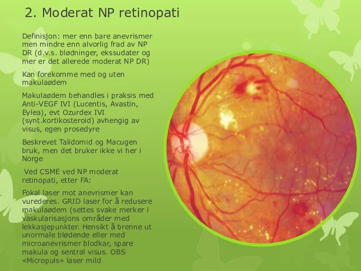 2. Moderat NP retinopati Definisjon: mer enn bare anevrismer men mindre enn