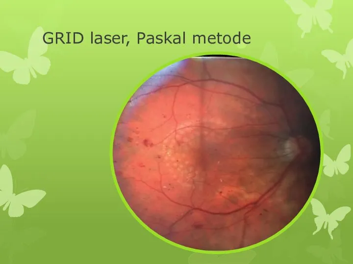 GRID laser, Paskal metode