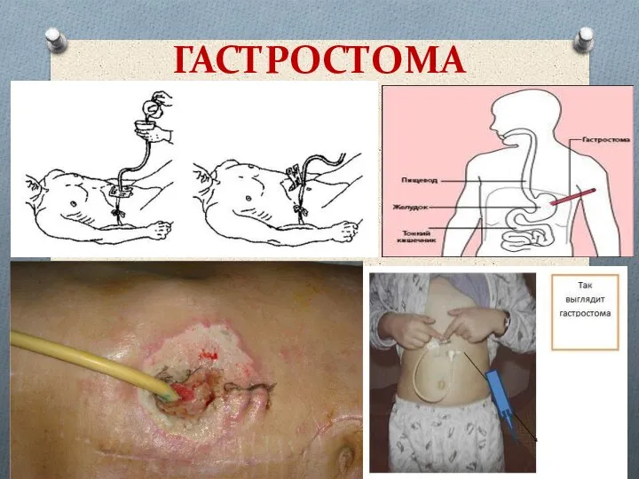 ГАСТРОСТОМА