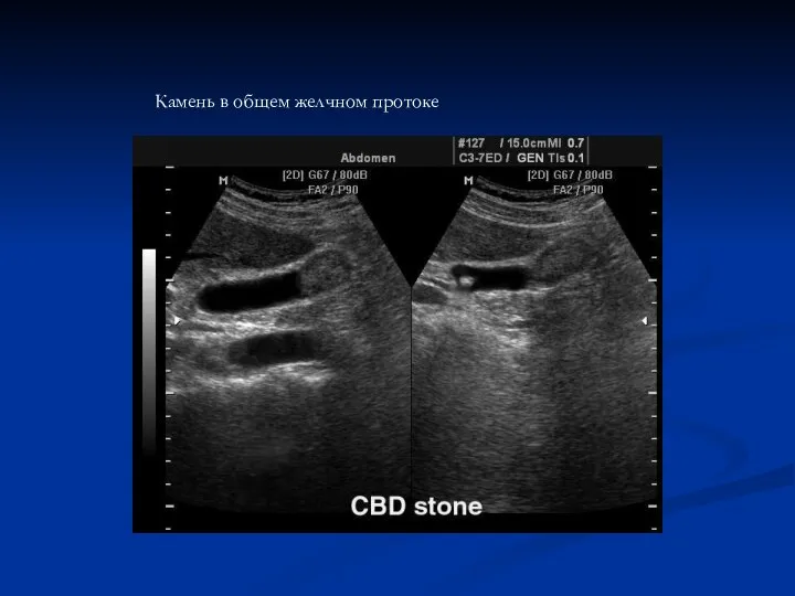 Камень в общем желчном протоке