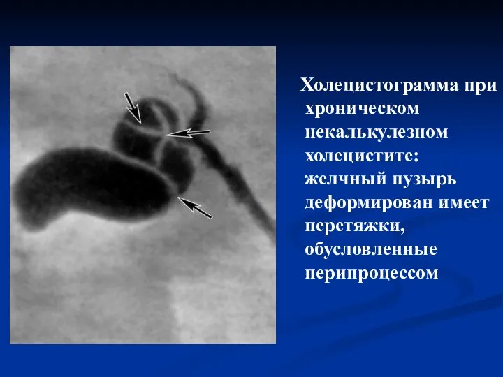 Холецистограмма при хроническом некалькулезном холецистите: желчный пузырь деформирован имеет перетяжки, обусловленные перипроцессом