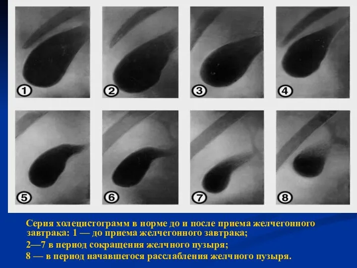 Серия холецистограмм в норме до и после приема желчегонного завтрака: 1 —